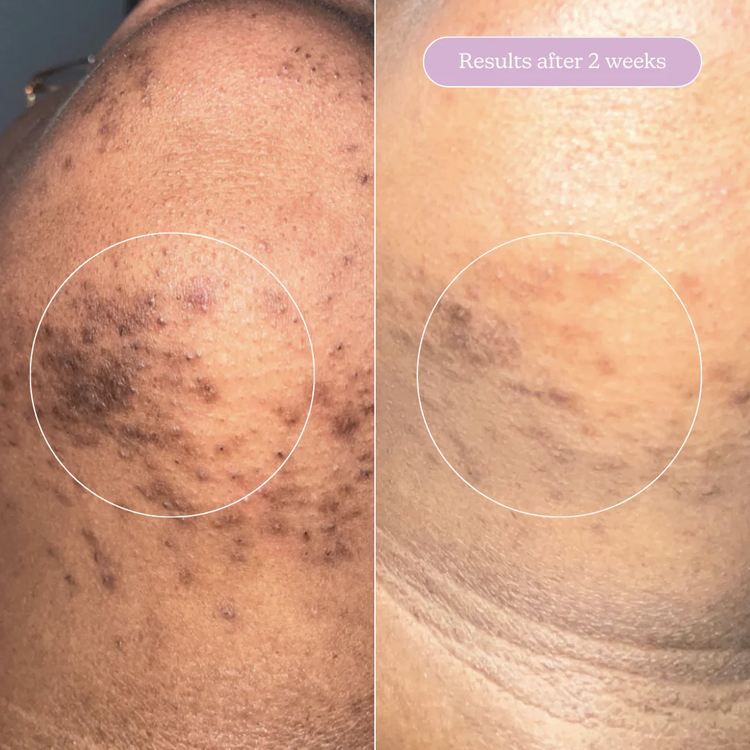 Acne Treat & Fade Bundle - Image 9